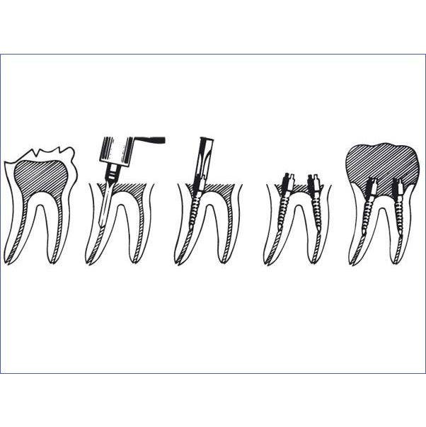 Pivoți Mira-Post Reamer set 6 buc Hager
